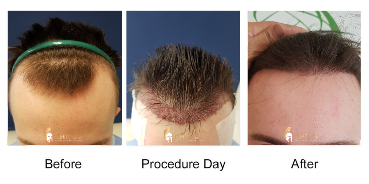 FUE – Μεταμόσχευση μαλλιών με μεταφορά μεμονωμένων τριχοθυλακίων