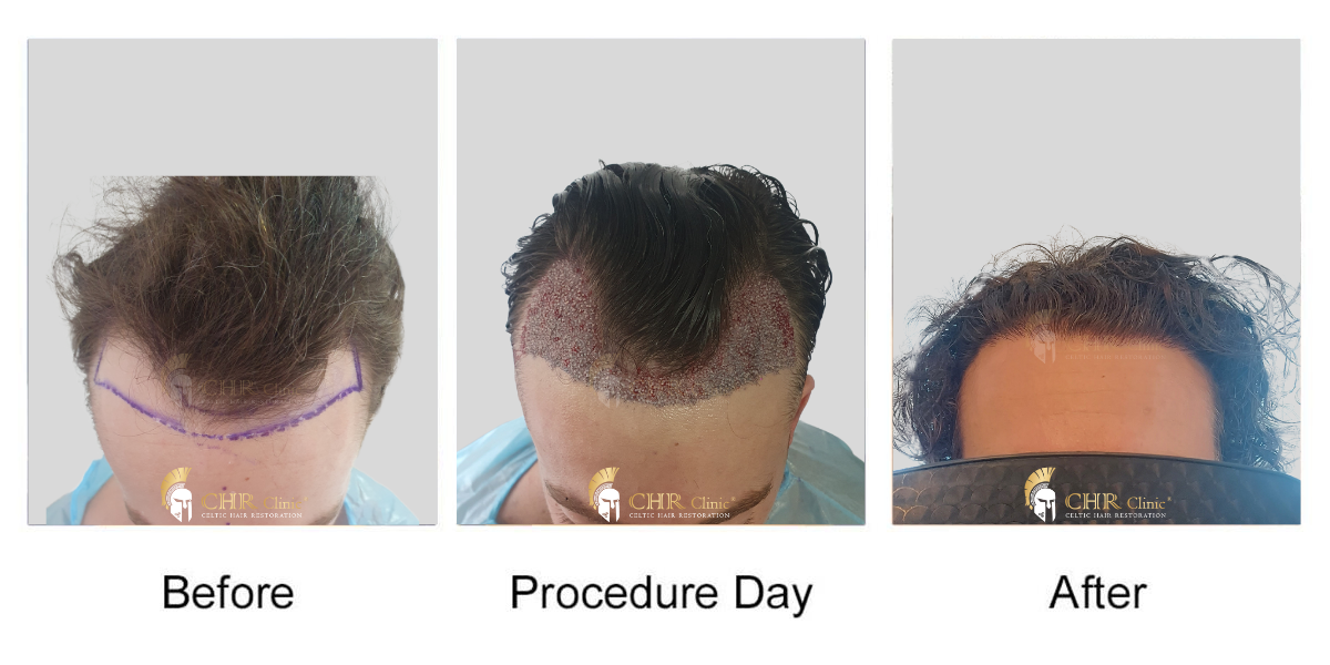 FUE – Μεταμόσχευση μαλλιών με μεταφορά μεμονωμένων τριχοθυλακίων
