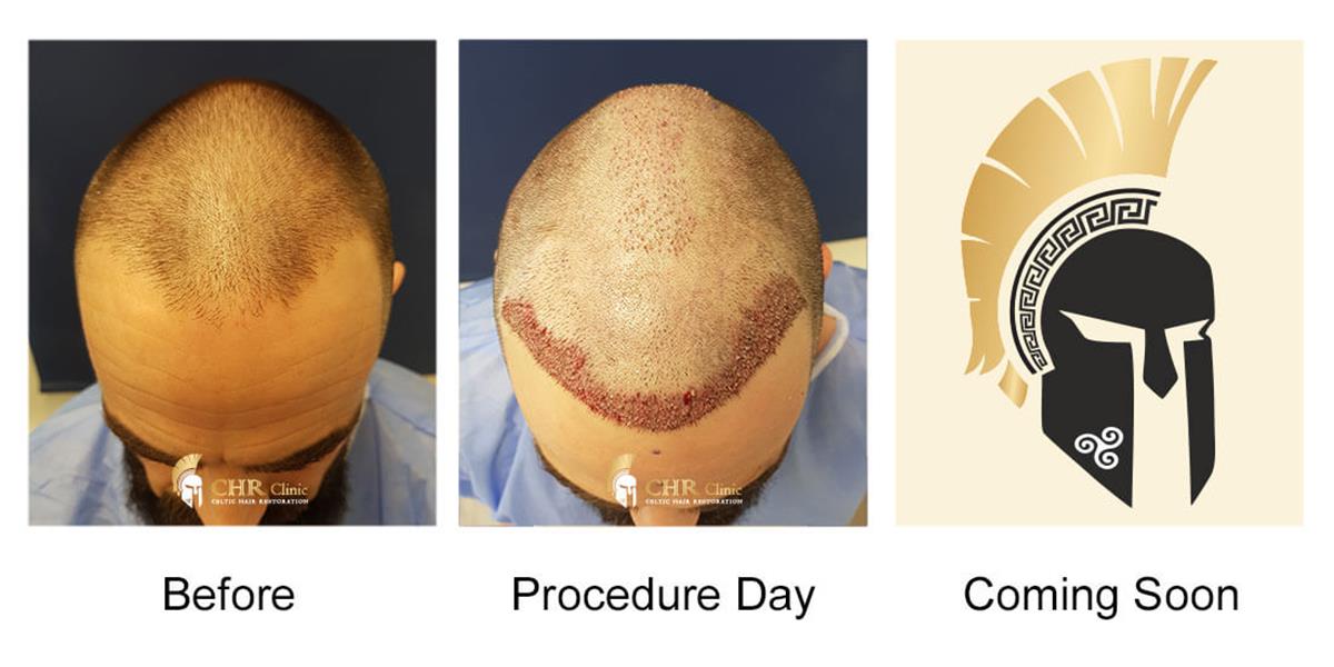 FUE - Follicular Unit Extraction Hair Transplantation 