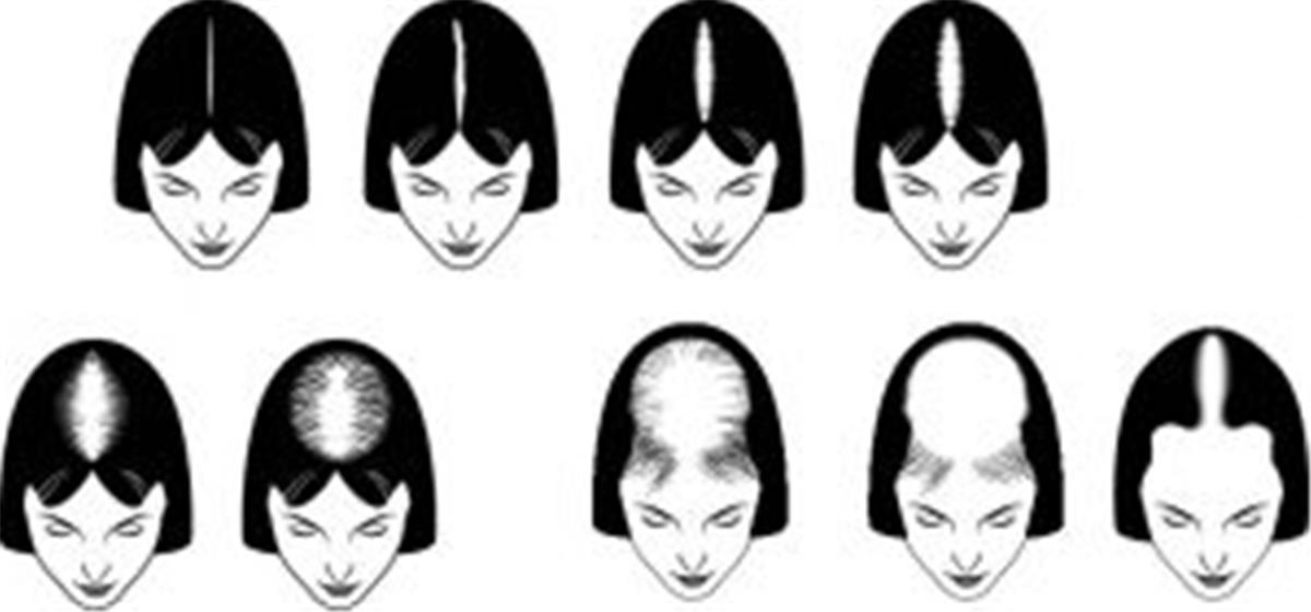 Women Hair Loss Information - CHR Clinic